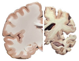 Alzheimer's Disease Brain